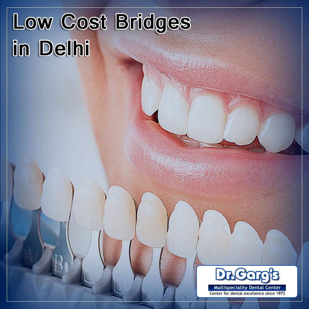 Dental Bridges Cost in India